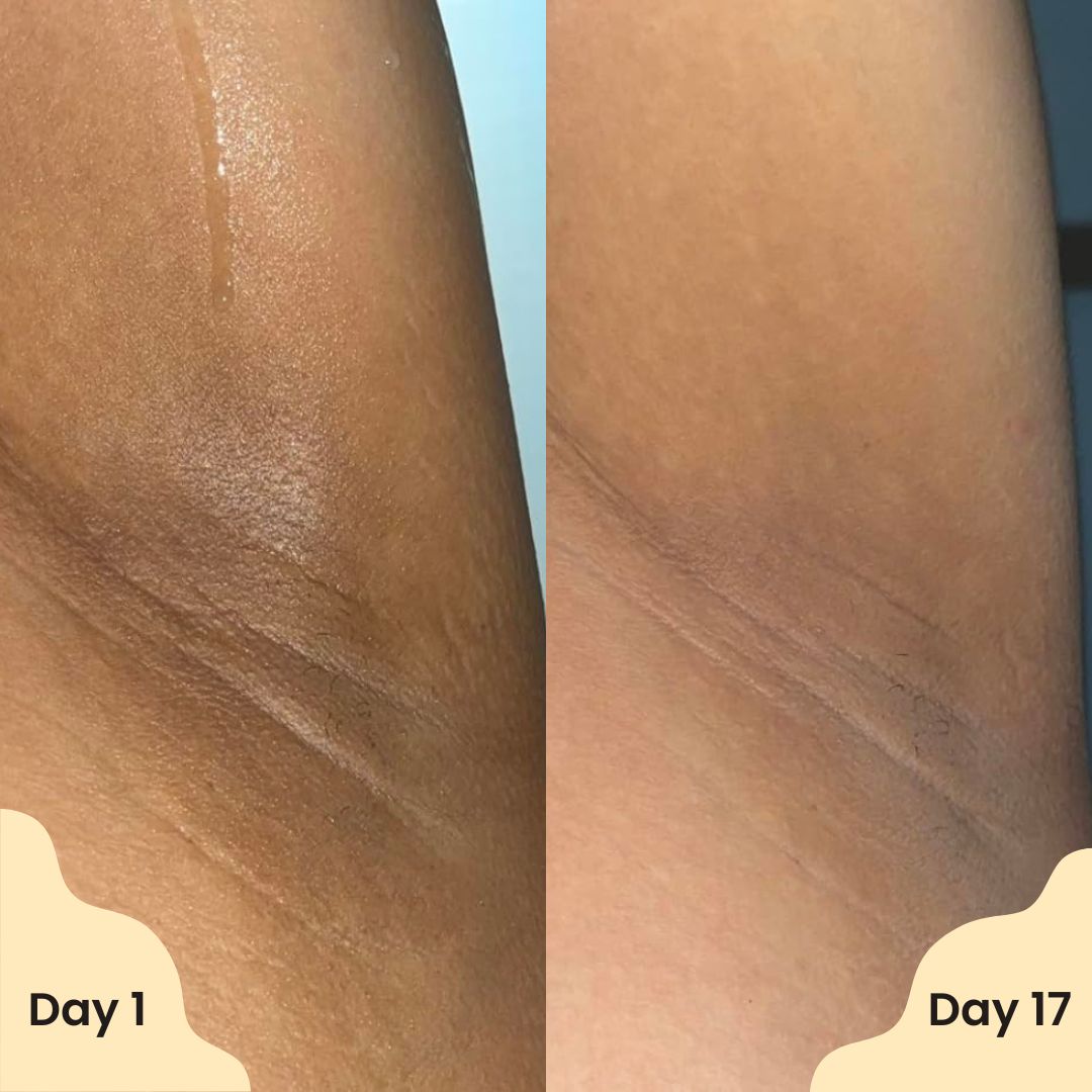 ✨ Zyvenex® Vanilla Pistachio Brightening Deodorant — Smooth skin Underarms in Just Weeks 💛 ✨