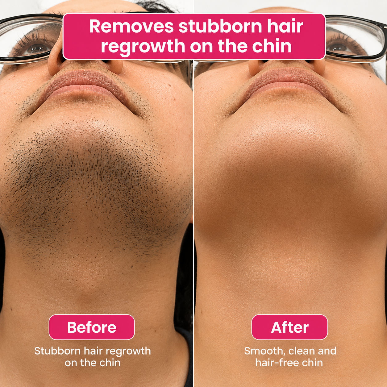 🔥LAST DAY 60% OFF Zyvenex Hair Reduction Oil 60 ml – Permanent Hair Removal Oil