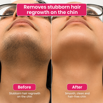🔥LAST DAY 60% OFF Zyvenex Hair Reduction Oil 60 ml – Permanent Hair Removal Oil